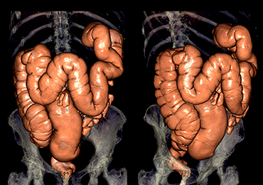 ¿Qué es el megacolon?