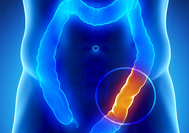 Factores de riesgo del cáncer de colon
