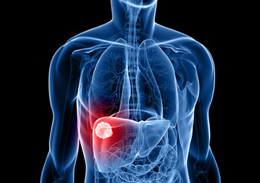La hepatitis C es la principal causa del hepatocarcinoma, el cáncer de hígado primario