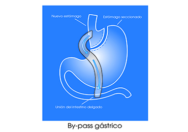 Tratamiento de la obesidad mediante bypass gástrico