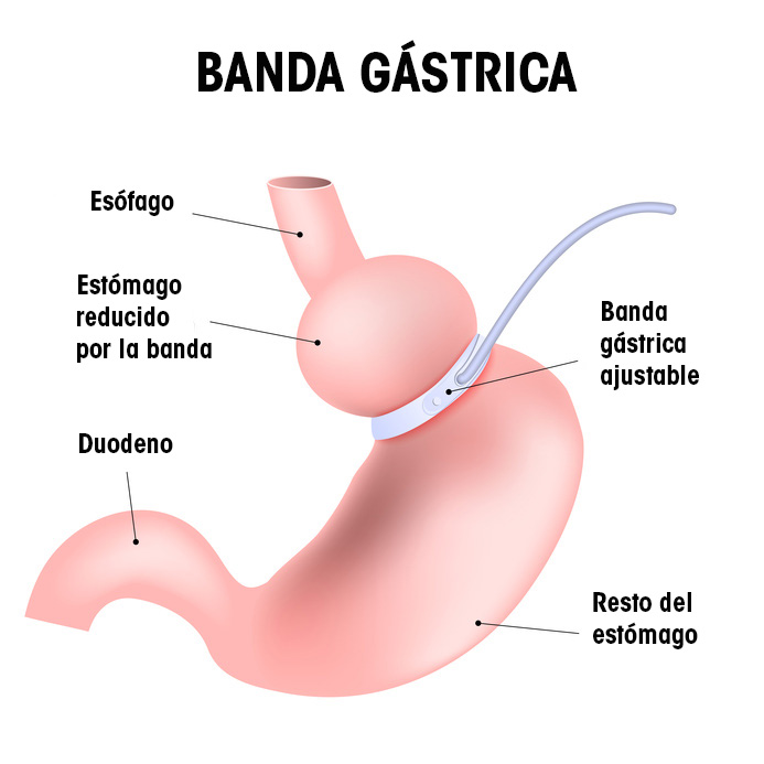 Banda gástrica ajustable para el tratamiento de la obesidad