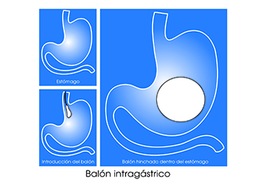 El balón gástrico para el tratamiento de la obesidad