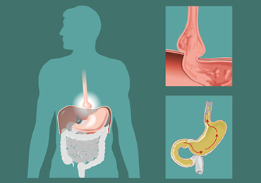 ¿Cómo es el tratamiento para la hernia de hiato?