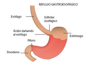 ¿Cómo afectan las bebidas con gas al reflujo?