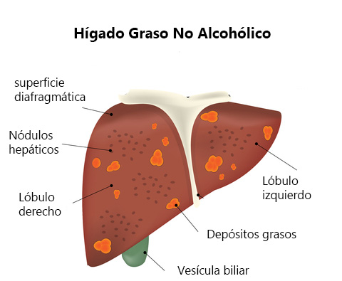 El hígado graso empeora tras los excesos del verano p