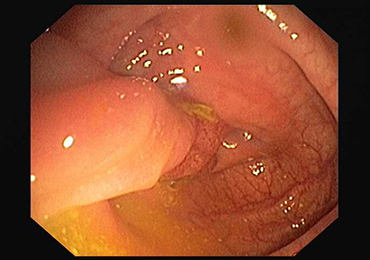 Etapas de los pólipos del colon y necesidad de colonoscopia periódica