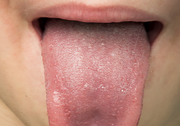 La lengua y las patologías digestivas