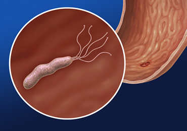 ¿Qué es el helicobacter pylori?