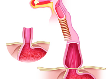 ¿Qué es la acalasia?