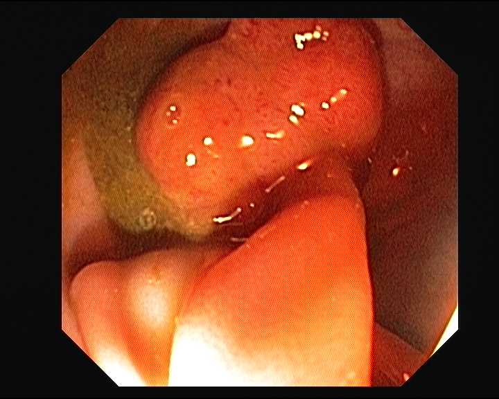 ¿Son hereditarios los pólipos en el colon?