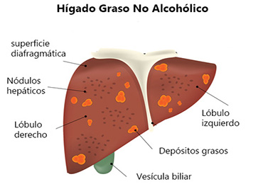 El hígado graso no alcohólico