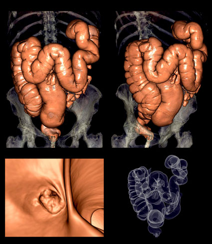 cancer malign la colon