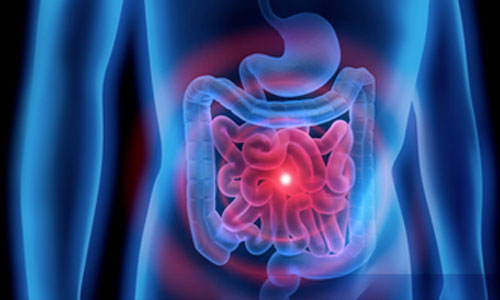 Inflammatory Bowel Disease