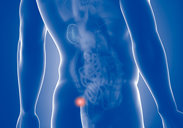 El cribado anal para detectar el VPH evitaría la mayoría de los cánceres anales