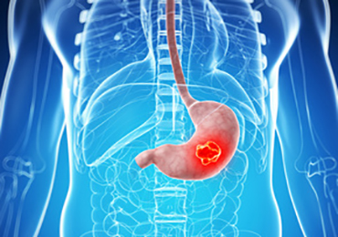 ¿Con qué síntomas puede manifestarse el cáncer de estómago?