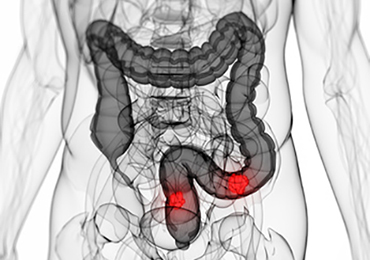 Dieta, alcohol, tabaco, sobrepeso y sedentarismo causas del aumento del cáncer de colon