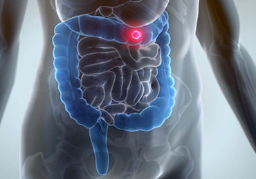  Relación entre el estado de la microbiota y el cáncer de colon