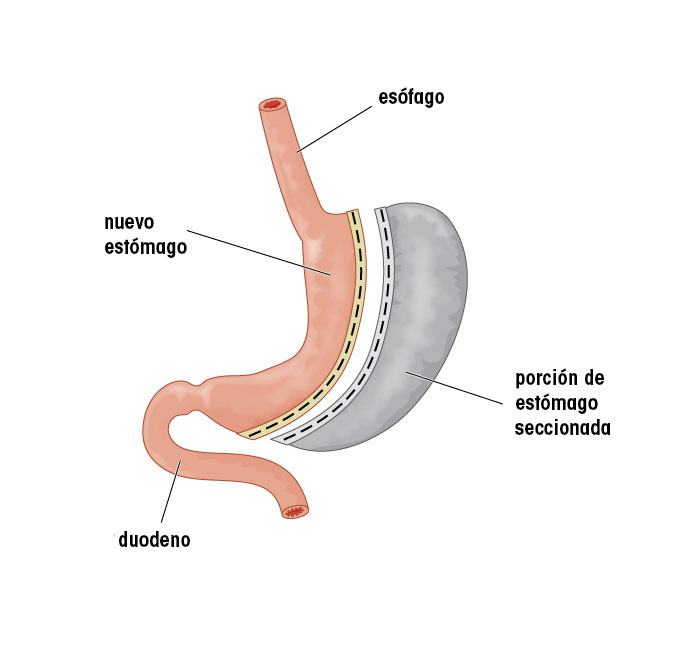Reducción de estómago mediante técnicas restrictivas: la gastrectomía tubular 