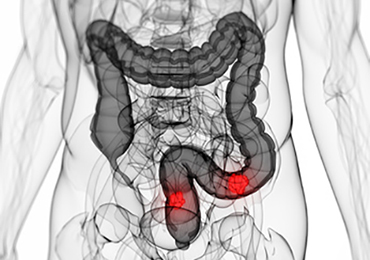 Síntomas para identificar el cáncer de colon