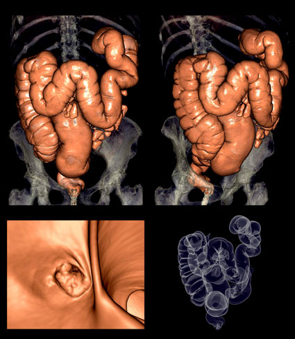El cancer de colon como se manifiesta - Video CSID - El cancer de colon como se manifiesta