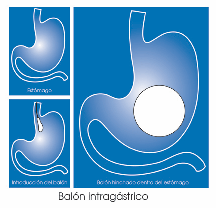 balon intragastrico
