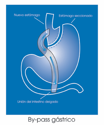 bypass grastico