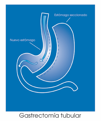gastrectomia