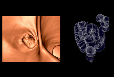 Colonoscopia Virtual