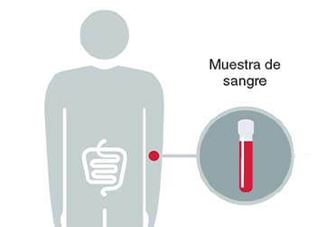 TEST DCC (CÁNCER DE COLON)