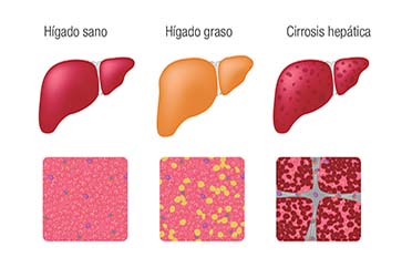 TEST HGA (HÍGADO GRASO NO ALCOHÓLICO)