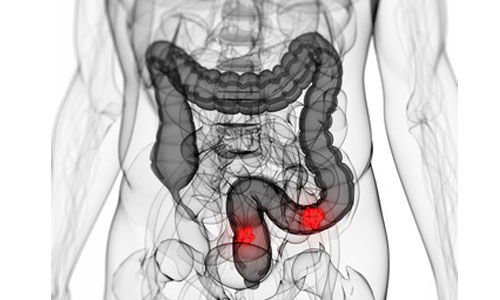 Colon Cancer